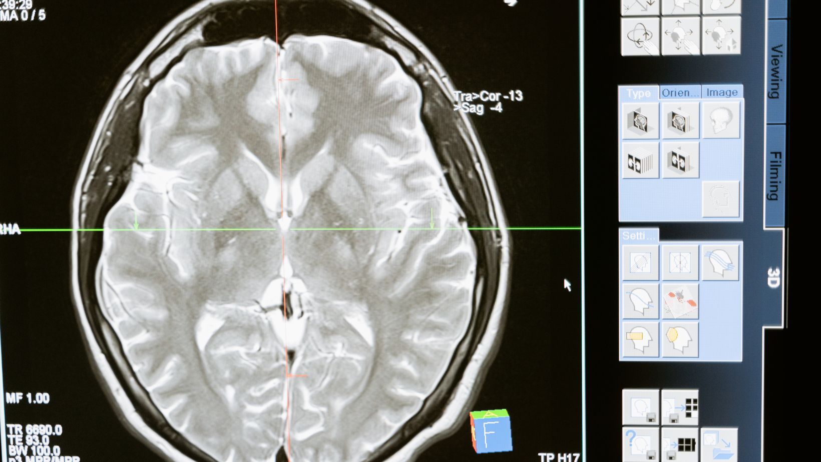 Brain Tumor Research Breakthroughs Advancements In Understanding And